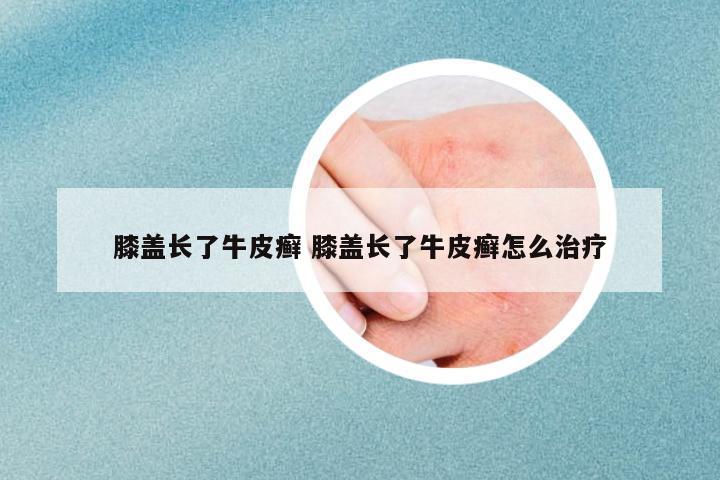 膝蓋長了牛皮癬 膝蓋長了牛皮癬怎么治療