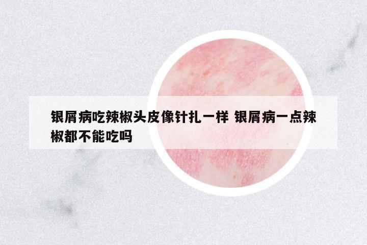 銀屑病吃辣椒頭皮像針扎一樣 銀屑病一點(diǎn)辣椒都不能吃嗎