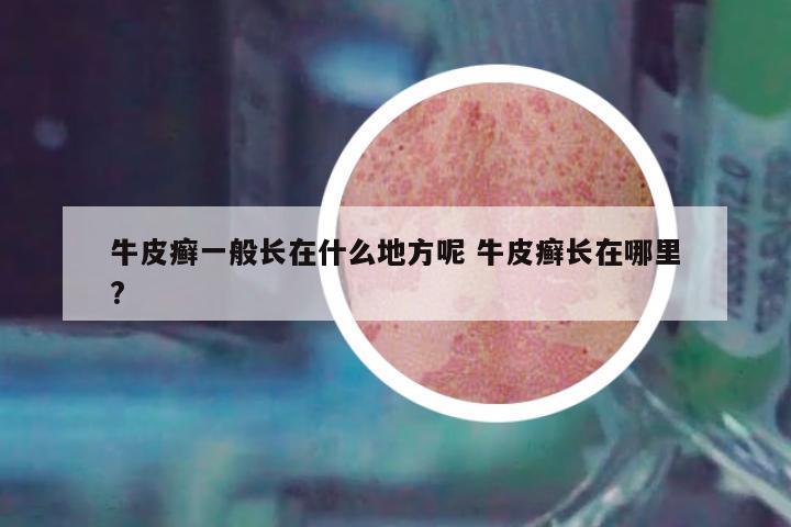 牛皮癬一般長在什么地方呢 牛皮癬長在哪里?