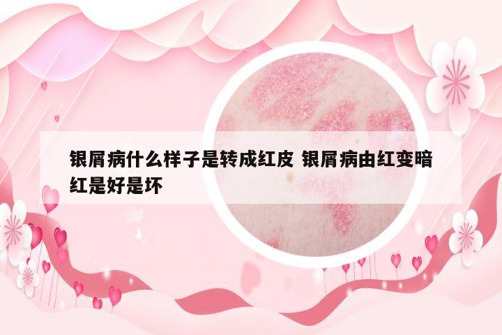 銀屑病什么樣子是轉(zhuǎn)成紅皮 銀屑病由紅變暗紅是好是壞