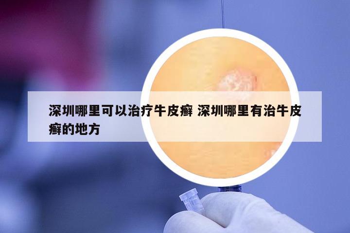 深圳哪里可以治療牛皮癬 深圳哪里有治牛皮癬的地方