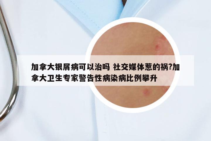 加拿大銀屑病可以治嗎 社交媒體惹的禍?加拿大衛(wèi)生專(zhuān)家警告性病染病比例攀升