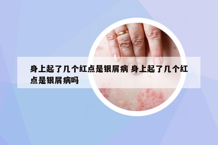 身上起了幾個(gè)紅點(diǎn)是銀屑病 身上起了幾個(gè)紅點(diǎn)是銀屑病嗎