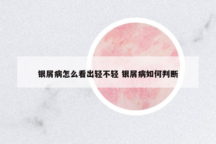銀屑病怎么看出輕不輕 銀屑病如何判斷