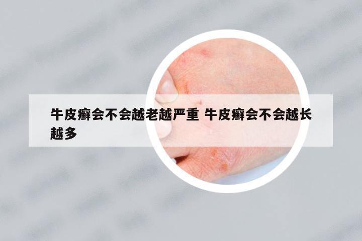 牛皮癬會不會越老越嚴重 牛皮癬會不會越長越多