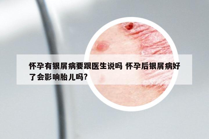 懷孕有銀屑病要跟醫(yī)生說(shuō)嗎 懷孕后銀屑病好了會(huì)影響胎兒?jiǎn)?