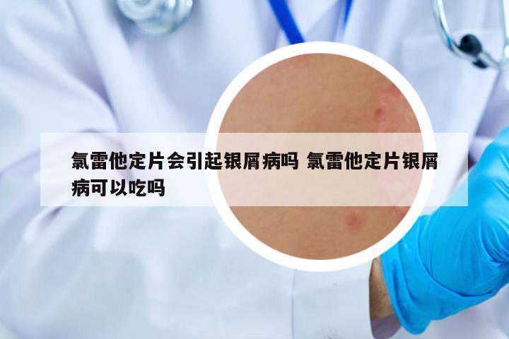 氯雷他定片會引起銀屑病嗎 氯雷他定片銀屑病可以吃嗎