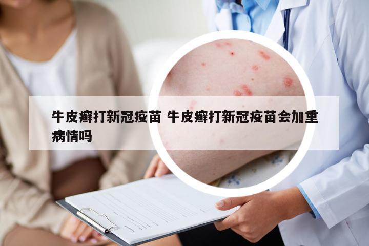 牛皮癬打新冠疫苗 牛皮癬打新冠疫苗會加重病情嗎