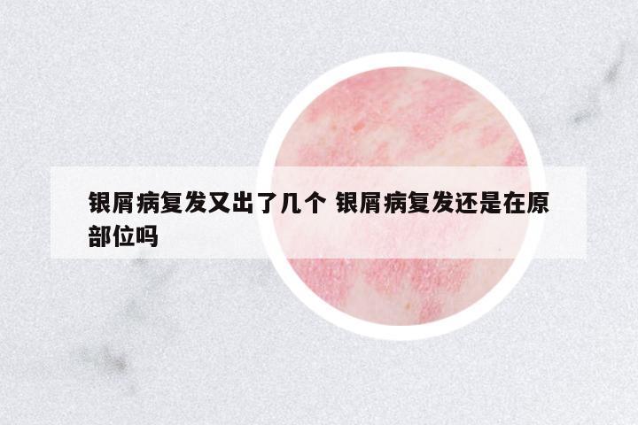 銀屑病復(fù)發(fā)又出了幾個(gè) 銀屑病復(fù)發(fā)還是在原部位嗎