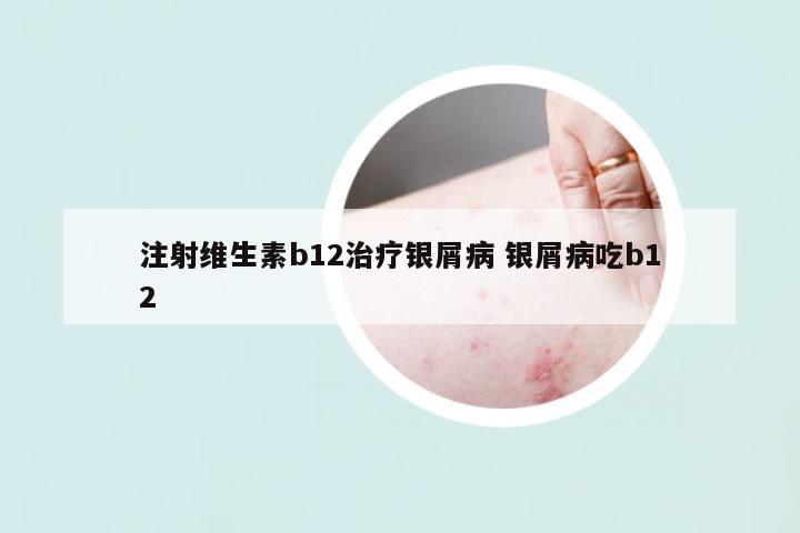 注射維生素b12治療銀屑病 銀屑病吃b12