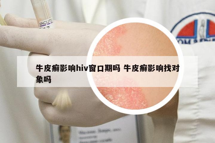 牛皮癬影響hiv窗口期嗎 牛皮癬影響找對象嗎