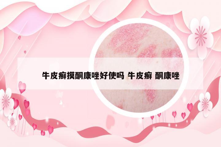 牛皮癬摸酮康唑好使嗎 牛皮癬 酮康唑