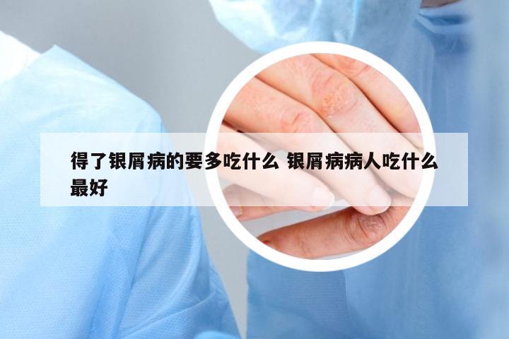 得了銀屑病的要多吃什么 銀屑病病人吃什么最好