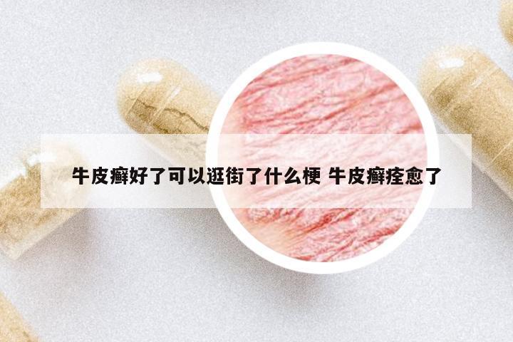 牛皮癬好了可以逛街了什么梗 牛皮癬痊愈了