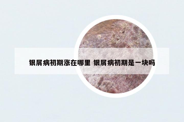 銀屑病初期漲在哪里 銀屑病初期是一塊嗎