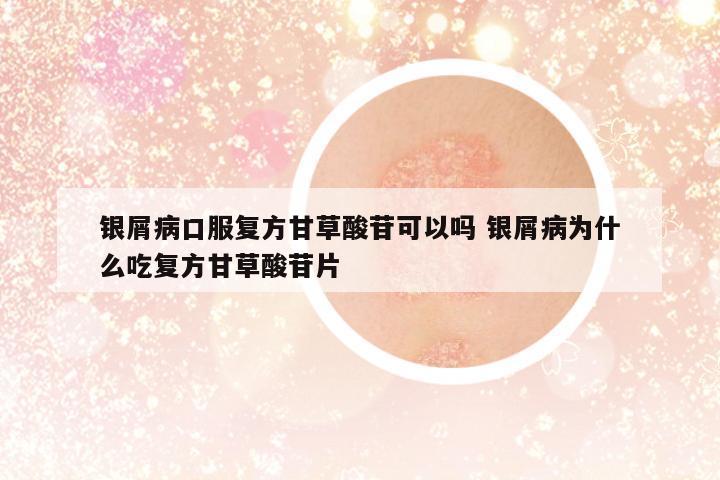 銀屑病口服復方甘草酸苷可以嗎 銀屑病為什么吃復方甘草酸苷片