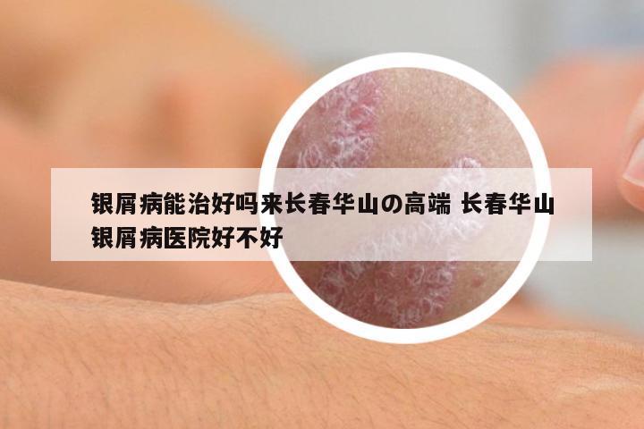 銀屑病能治好嗎來長春華山の高端 長春華山銀屑病醫(yī)院好不好