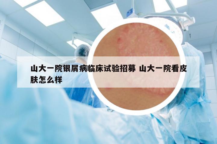 山大一院銀屑病臨床試驗(yàn)招募 山大一院看皮膚怎么樣