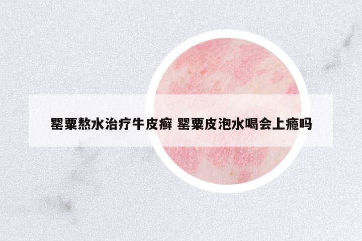 罌粟熬水治療牛皮癬 罌粟皮泡水喝會(huì)上癮嗎