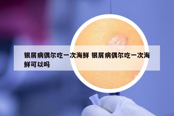 銀屑病偶爾吃一次海鮮 銀屑病偶爾吃一次海鮮可以嗎
