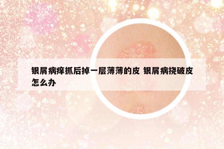 銀屑病癢抓后掉一層薄薄的皮 銀屑病撓破皮怎么辦