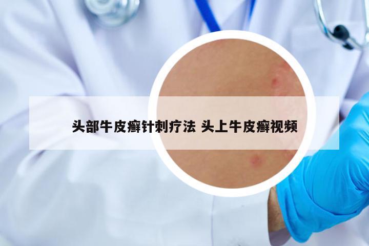 頭部牛皮癬針刺療法 頭上牛皮癬視頻