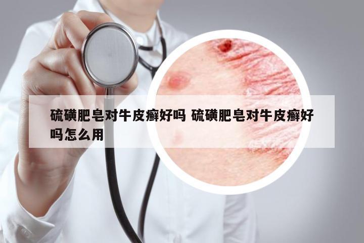 硫磺肥皂對牛皮癬好嗎 硫磺肥皂對牛皮癬好嗎怎么用