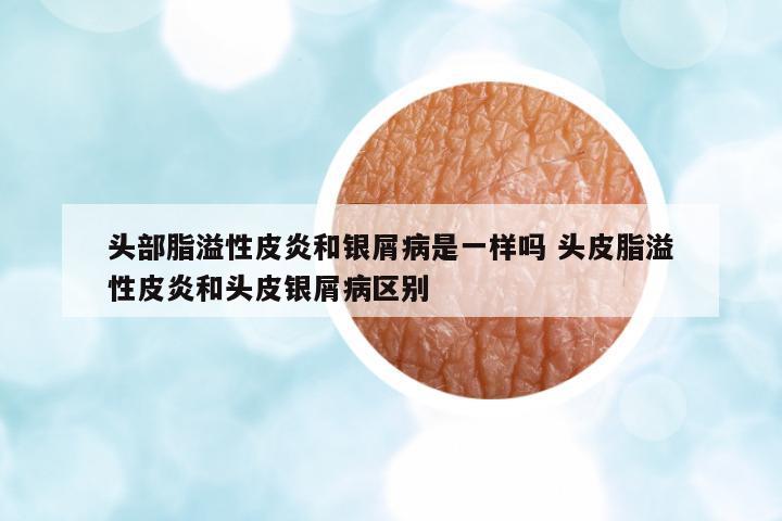 頭部脂溢性皮炎和銀屑病是一樣嗎 頭皮脂溢性皮炎和頭皮銀屑病區(qū)別