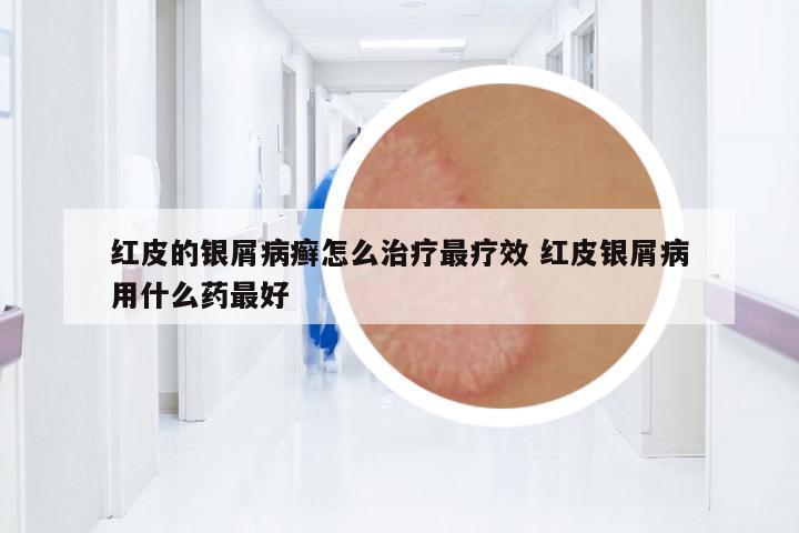 紅皮的銀屑病癬怎么治療最療效 紅皮銀屑病用什么藥最好