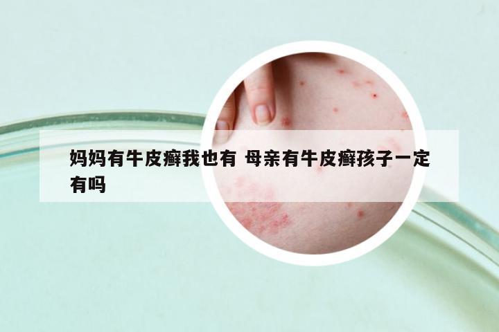 媽媽有牛皮癬我也有 母親有牛皮癬孩子一定有嗎