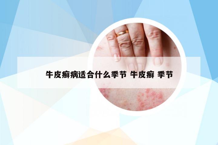 牛皮癬病適合什么季節(jié) 牛皮癬 季節(jié)