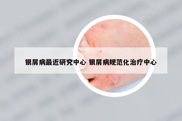 銀屑病最近研究中心 銀屑病規(guī)范化治療中心