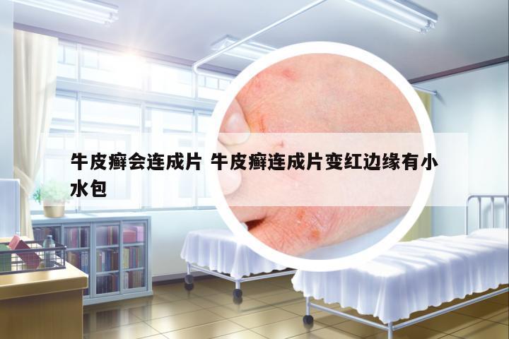 牛皮癬會(huì)連成片 牛皮癬連成片變紅邊緣有小水包