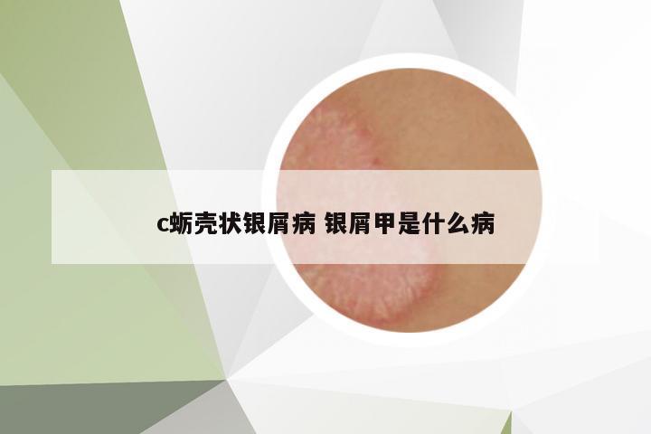 c蠣殼狀銀屑病 銀屑甲是什么病