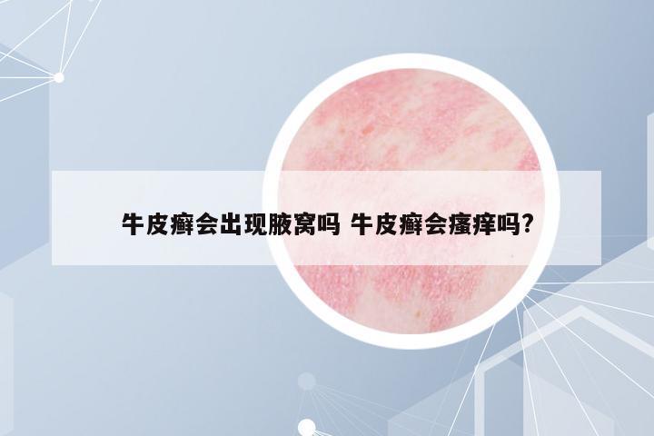 牛皮癬會出現(xiàn)腋窩嗎 牛皮癬會瘙癢嗎?