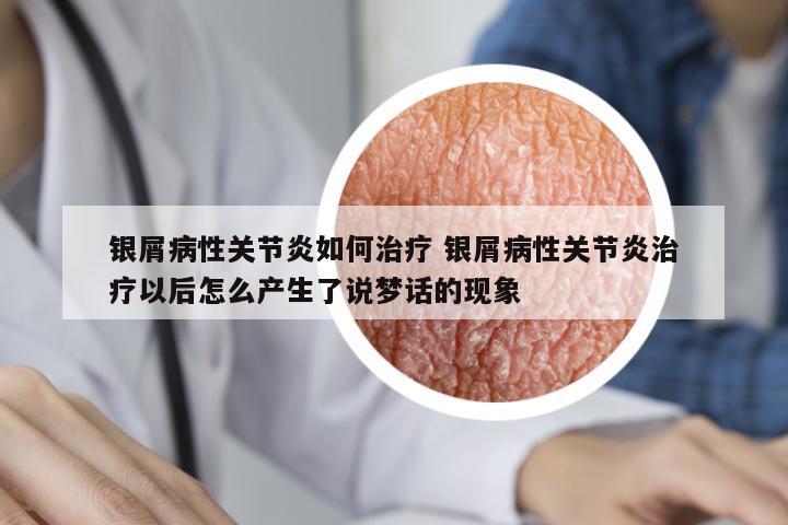 銀屑病性關(guān)節(jié)炎如何治療 銀屑病性關(guān)節(jié)炎治療以后怎么產(chǎn)生了說夢(mèng)話的現(xiàn)象