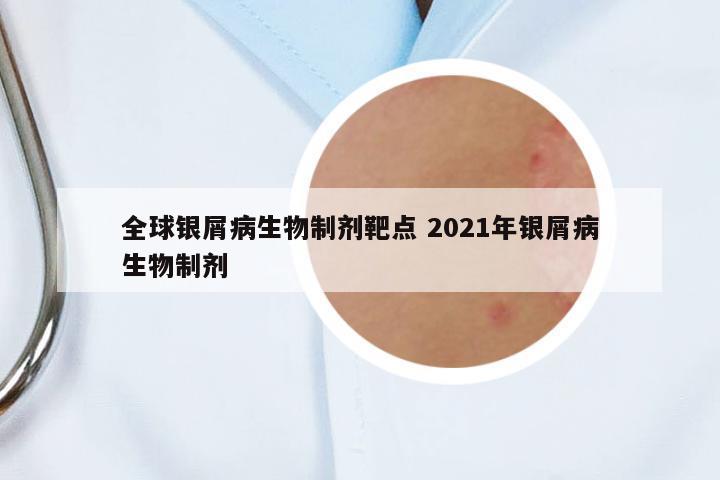 全球銀屑病生物制劑靶點(diǎn) 2021年銀屑病生物制劑