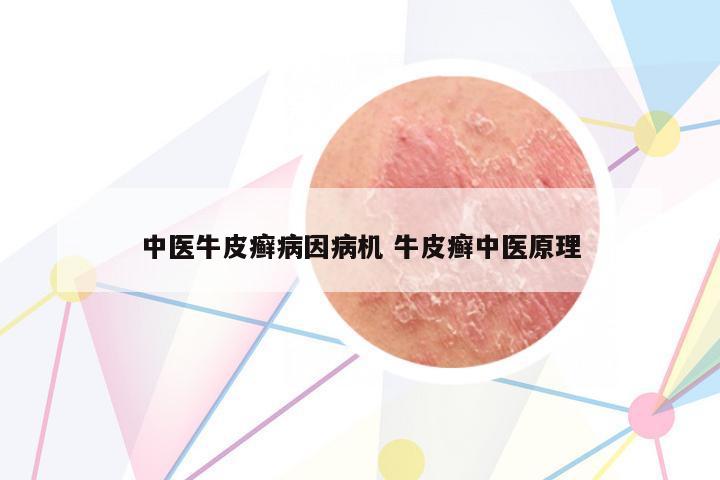中醫(yī)牛皮癬病因病機 牛皮癬中醫(yī)原理