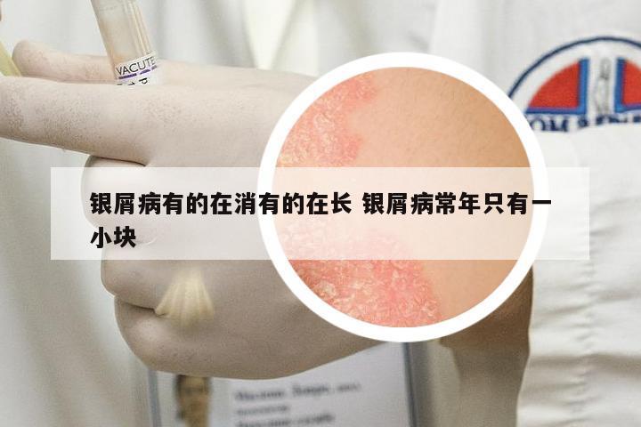 銀屑病有的在消有的在長(zhǎng) 銀屑病常年只有一小塊