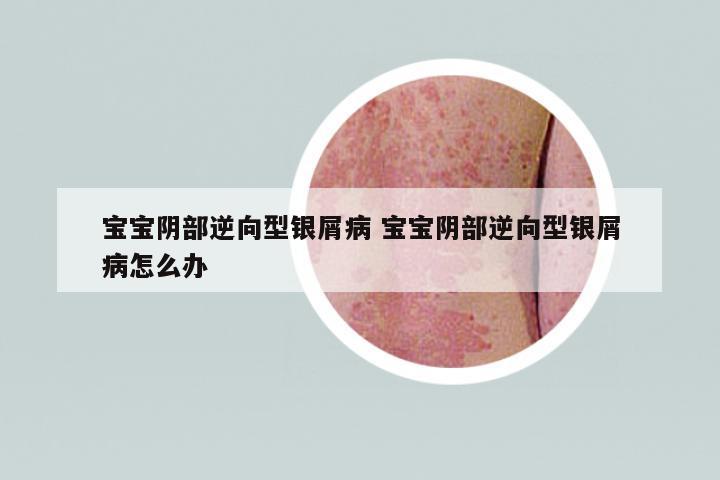 寶寶陰部逆向型銀屑病 寶寶陰部逆向型銀屑病怎么辦