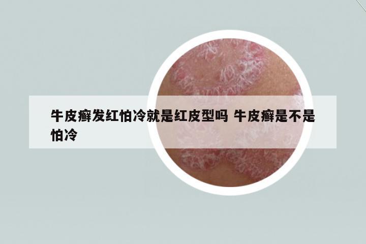 牛皮癬發(fā)紅怕冷就是紅皮型嗎 牛皮癬是不是怕冷