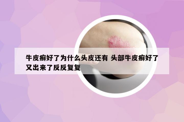 牛皮癬好了為什么頭皮還有 頭部牛皮癬好了又出來(lái)了反反復(fù)復(fù)