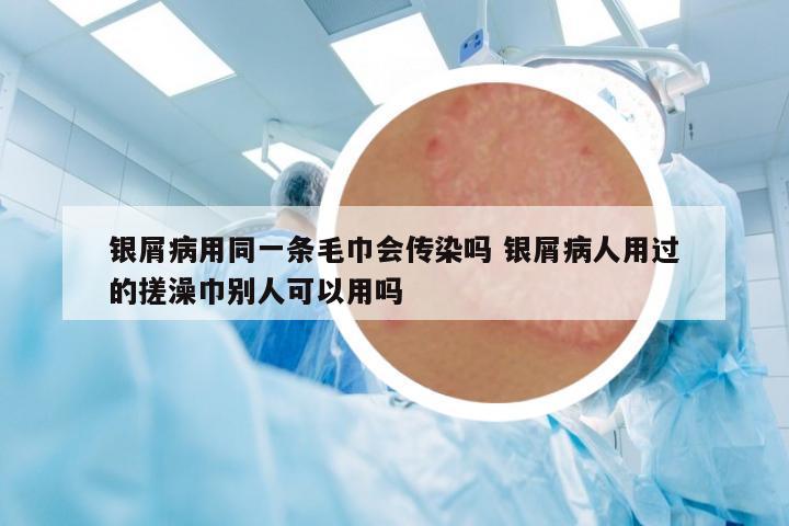 銀屑病用同一條毛巾會(huì)傳染嗎 銀屑病人用過(guò)的搓澡巾別人可以用嗎