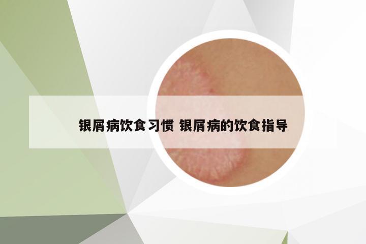 銀屑病飲食習(xí)慣 銀屑病的飲食指導(dǎo)