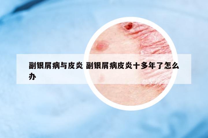 副銀屑病與皮炎 副銀屑病皮炎十多年了怎么辦