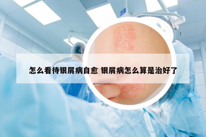 怎么看待銀屑病自愈 銀屑病怎么算是治好了