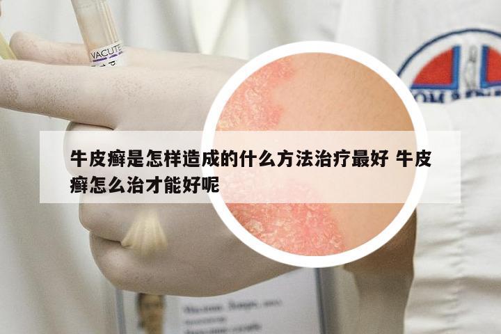 牛皮癬是怎樣造成的什么方法治療最好 牛皮癬怎么治才能好呢