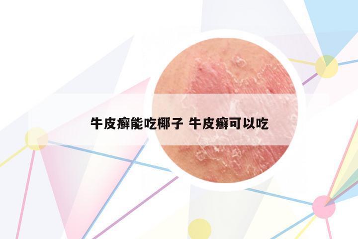 牛皮癬能吃椰子 牛皮癬可以吃