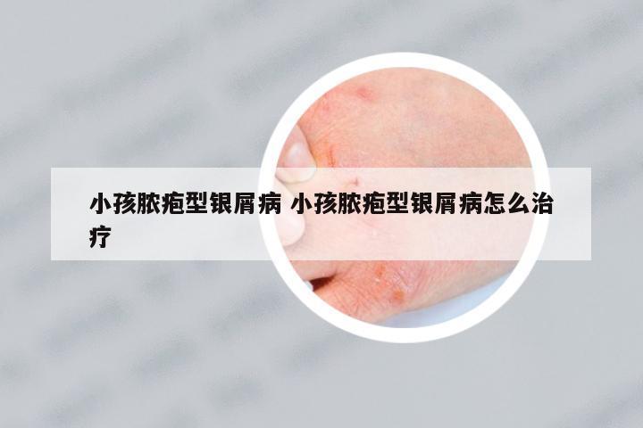 小孩膿皰型銀屑病 小孩膿皰型銀屑病怎么治療