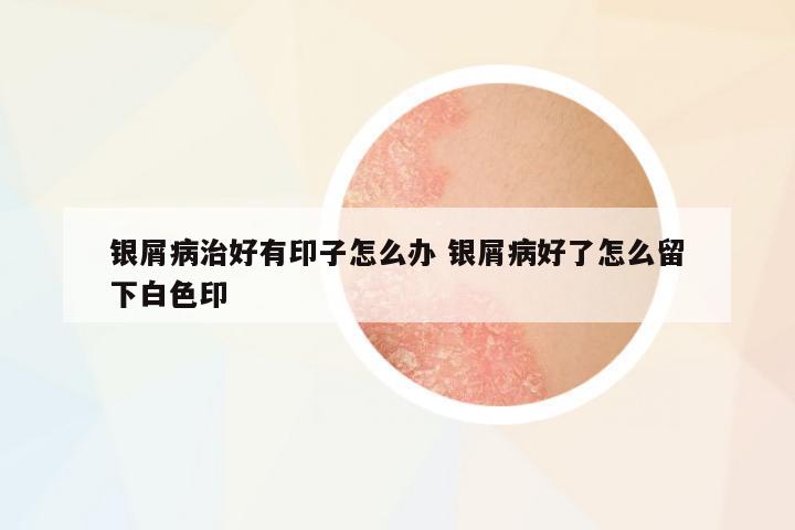 銀屑病治好有印子怎么辦 銀屑病好了怎么留下白色印
